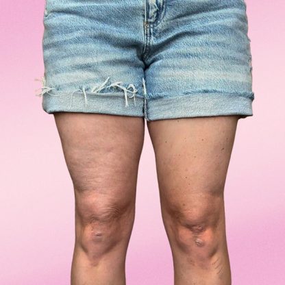 10x InvisiLift Flasteri za Podizanje Kože